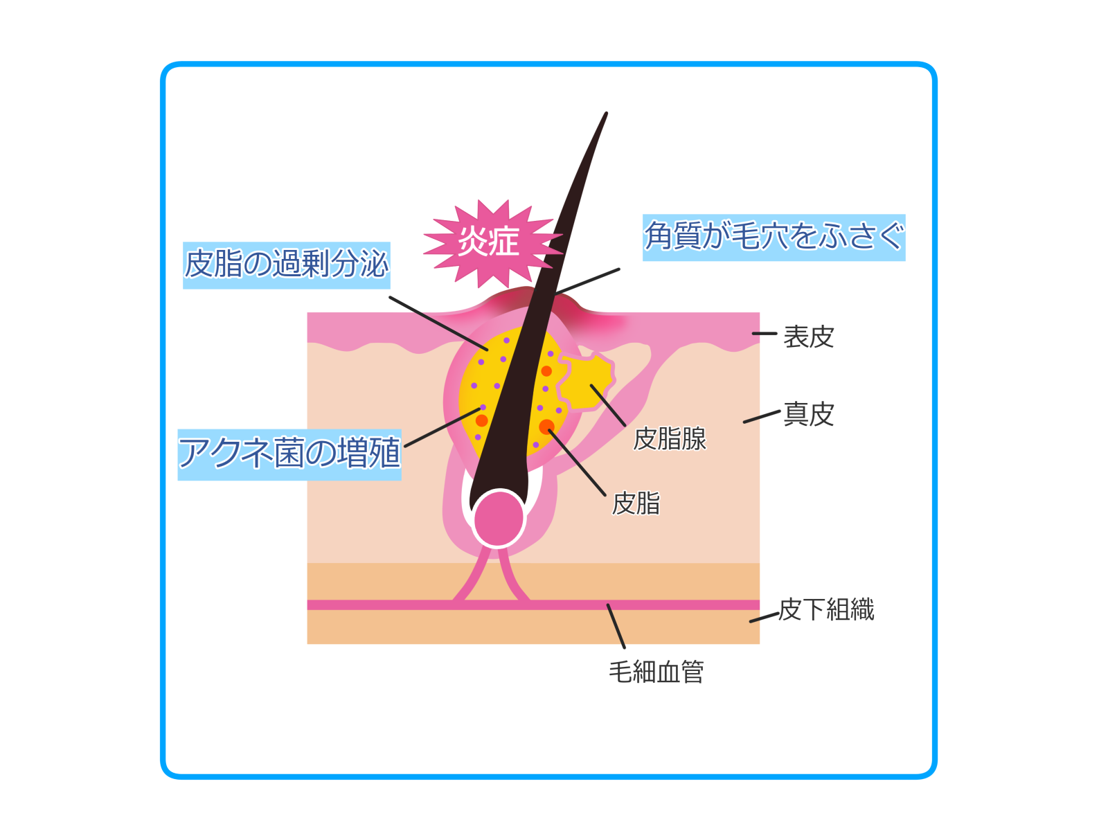 ニキビは角質・過剰な皮脂が毛穴をふさぎアクネ菌が増殖することでできることを示す画像